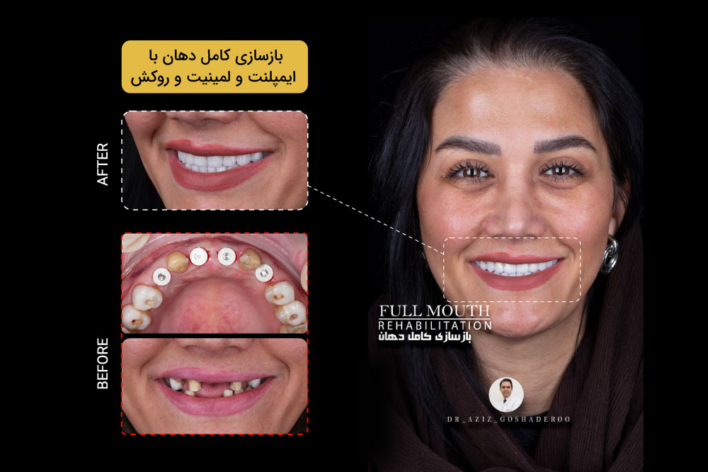 ایمپلنت دندان چیست؟